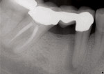 Initial presentation radiograph revealed an apicomarginal bony defect along the distal aspect of tooth No. 29. The diagnosis for tooth No. 29 was pulp necrosis with chronic apical abscess, complicated by primary endo/secondary perio pathoses.
