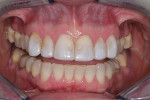 Preoperative smile (retracted view).