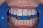 Application of tint for incisal characterization.