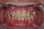 Posttreatment smile, retracted smile view, and retracted maxillary incisal view.