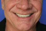 Fig 9. Maxillary trial smile in place.