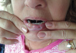 Fig 1. Large ulcer on right lower lip with pseudomembrane. A smaller ulcer was located on the left side of the lip.