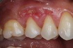 Fig 1. Pretreatment intraoral photograph, right maxillary premolar region, showing exposed alveolar bone with inflamed gingival margins at the wound.