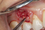 Fig 5. Osseous recontouring achieved and bony bleeding induced.