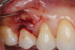 Fig 3 and Fig 4. Gingival margin elevation performed with a microsurgical periosteal
elevator.
