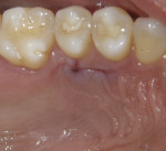Fig 7. Palatal mucosa after retrieval of the connective tissue graft.