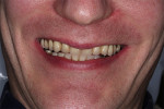 Fig 3. Patient’s smile after multiple repairs of existing hybrid prostheses.