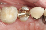 Figure 4  Preoperative views of tooth No. 4.