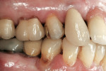 Figure 5  Preoperative views of tooth No. 4.