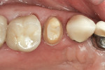 Figure 7  Preparation for a Lava zirconia crown on tooth No. 4.