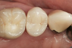Figure 9: Zirconia crown on tooth No. 4.