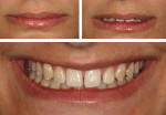 Fig 2. Extraoral photographic protocol showing relationship between patient’s smile, lips, and teeth disposition. Upper left: sealed lips; upper right: discrete opened lips; bottom: wide smile.
