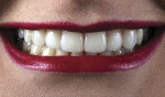 Fig 14. Follow-up at 18 months. The all-ceramic restorations presented an esthetic appearance similar to when they were placed, and no failure of veneers was observed.
