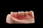 Fig 4. The 3D-printed Valplast partial denture appears with fully customized and milled PMMA teeth from the DGSHAPE DWX-51D.