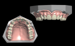 Fig 5. The teeth are arranged virtually, and wax is sculpted to finalize the digital denture design.
