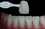Fig 2. This intraoral shade photograph is used for communication with the laboratory technician.
