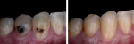 Fig 3. Intraoral photographs document the patient before and after treatment.