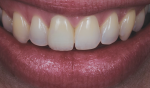 Fig 8. The dry skin and moist lips reflect and react to light differently than the wet oral mucosa.