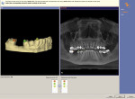 Fig 2 and Fig 3. Integration of data from CEREC and GALILEOS. Fig 2 shows matching landmarks on the model (top) and CBCT (bottom) before integration. Fig 3 shows post-integration image demonstrating perfect correlation of model (yellow line) to the CBCT information.