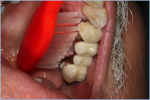 Fig 2. Simply positioning a toothbrush against teeth may not maximize contact between the bristles and the tooth surfaces.