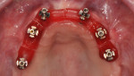 Fig 1. Maxillary segmented verification device inserted intraorally with 15 Ncm onto screw-retained abutments.