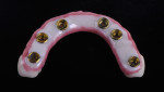 Fig 13. Maxillary definitive prosthesis with highly polished convex intaglio surface.