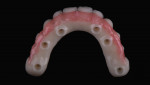 Fig 10. Milled maxillary PMMA prototype showing hygienic contours.