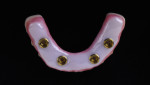 Fig 14. Mandibular definitive prosthesis with highly polished convex intaglio surface.