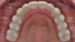 Fig 15. Maxillary definitive prosthesis, occlusal view.