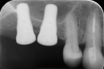 Fig 8. Periapical radiograph taken immediately after implant placement.