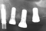 Fig 13. Periapical radiograph immediately after implant placement at sites Nos. 12 through 14.