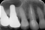 Fig 11. Twelve months after implant placement, periapical radiograph showed signs of mineralized bone in the sinus.
