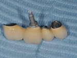 Disconnected implant-supported prosthesis.