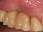Final implant-supported restorations.