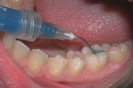 An etchant (37% phosphoric acid) is applied to the occlusal surface of tooth No. 19.