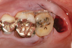 Fig 6. Postsurgical intraoral transplanted tooth without occlusal contacts.