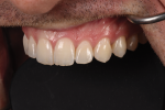 Fig 1. A look at natural teeth shows how embrasure space becomes larger in youthful teeth from central to first bicuspid.