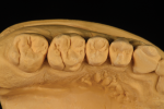 Fig 6. The maxillary contact area is shown from the occlusal view and interproximal view.