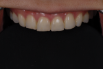 Fig 8. Facial view of older teeth shows the wear effects in the incisal area and how the papilla appears larger based on wear.