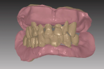 Fig 1. Maxillary and mandibular immediate denture image shows the reference dentition in brown. Digital tooth extraction has started; note space between teeth and ridge.