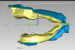 Fig 4. Inter-residual prosthetic space is evaluated and measured for planning overdenture design and tooth placement.