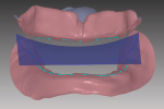 Fig 6. Ridge relationships are marked with dotted line and plane of occlusion is established with virtual set-up template.