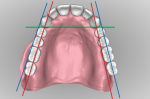 Fig 17. The patient’s right side is set on the ridge while the left side is buccal to ridge crest. The first and second molars should be moved so forces are over the ridge, not buccal to ridge.