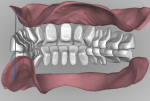 Fig 18. The ability to analyze tooth to ridge relationship by manipulating the design digitally provides a perspective that is impossible with a conventional wax tooth arrangement.
