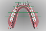 Fig 19. The mandibular posterior teeth are analyzed in relation to retromolar pads and ridge crest.