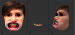 Fig 3. Images showing point-by-point alignment procedure of the face (a) and intraoral (b) 3D models. The same landmarks were marked in each model and then aligned by pairs from 0 to 3 in this case. The result of merging the two models can be seen from a lateral view (c); the face scan was made transparent.