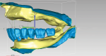 Fig 5. Mandibular teeth are set to determine prosthetic space and plane of occlusion for an
implant-supported overdenture.