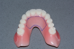 Fig 6. The denture is cut back 0.6 mm over the desired position.