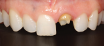 The patient presented with a missing crown on tooth No. 9 and was also unhappy with the chipped incisal edge of tooth No. 8.