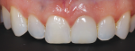 For the final result, a shade mixture was applied to add translucency to the mesial and distal line angles, and the facial surface was stained to match it to tooth No. 8.